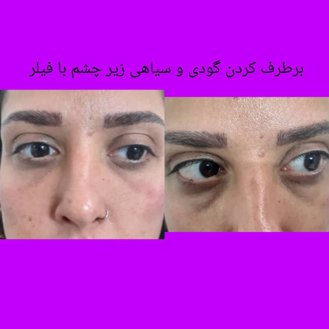 درمان لک و تیرگی پوست