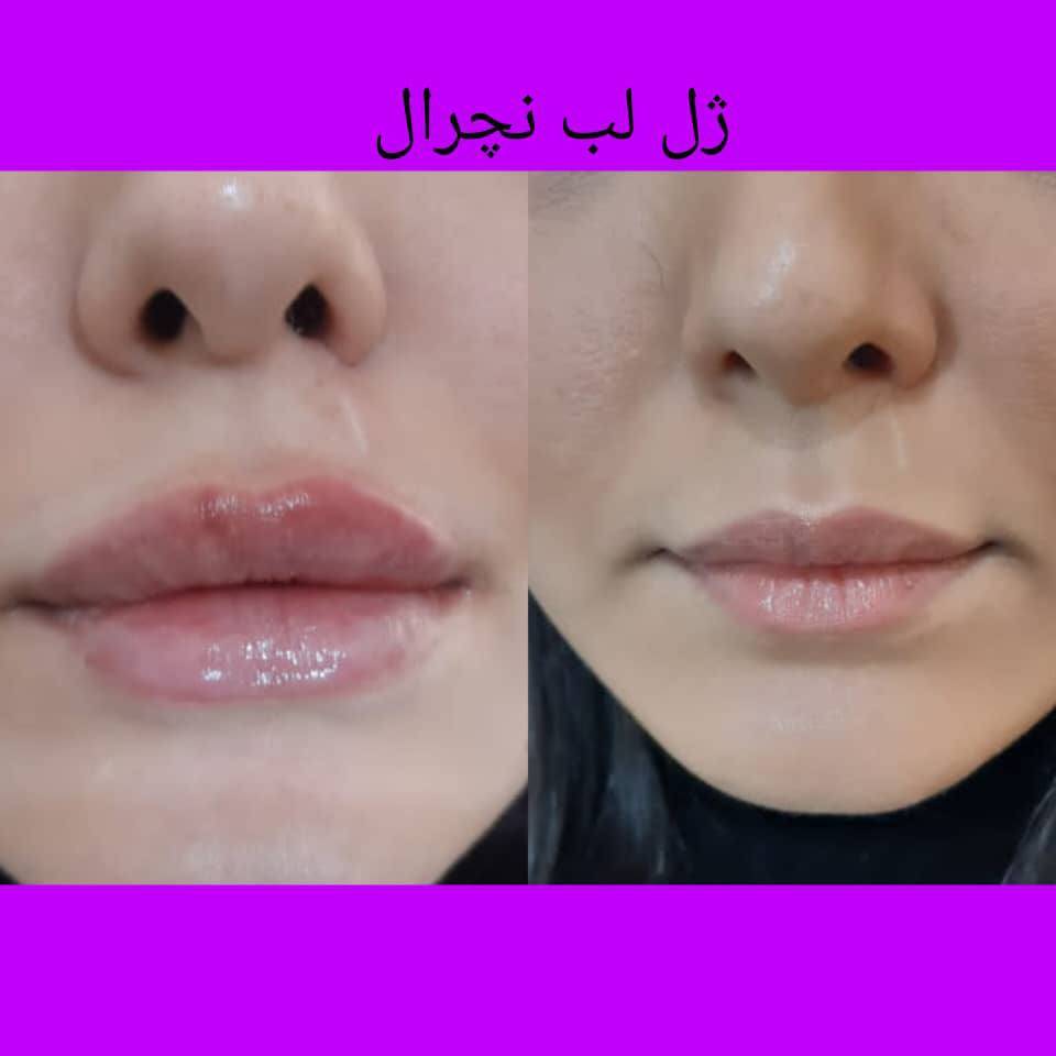 تزریق بوتاکس