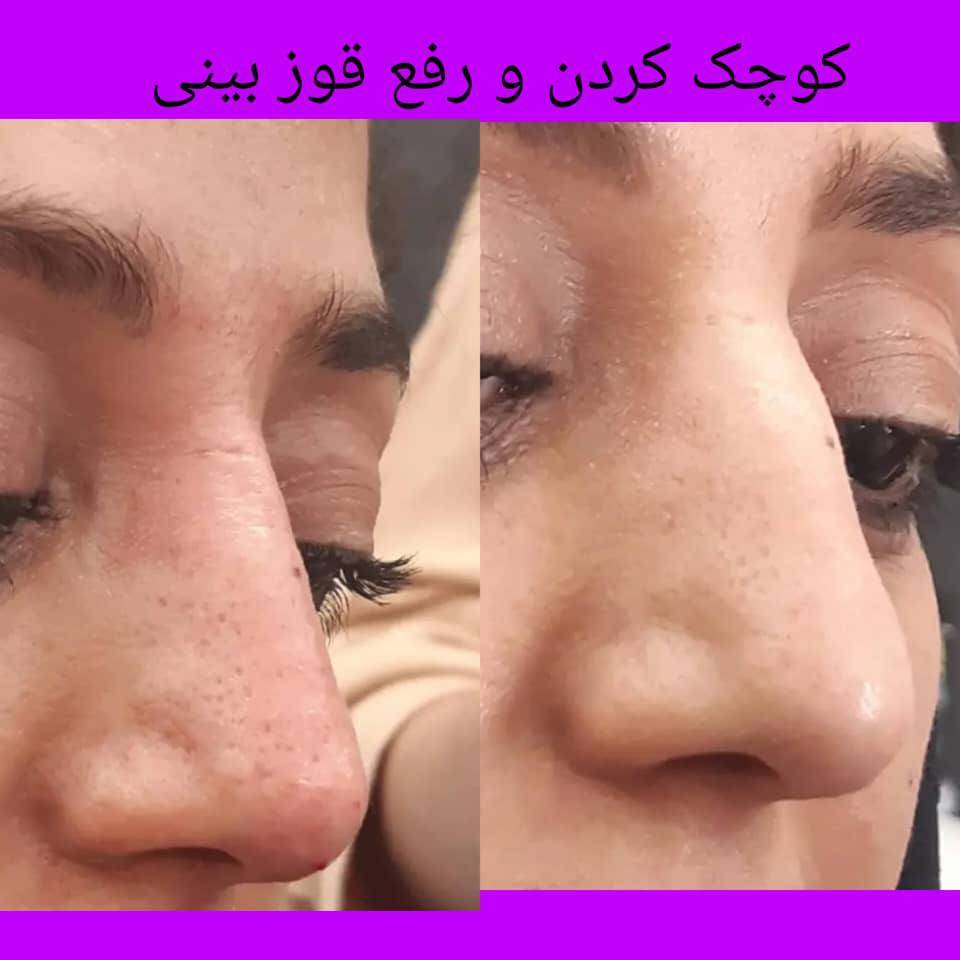 فیلر و فرم‌دهی صورت